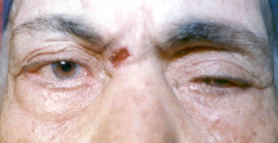 Eye Malignancies in Geriatric Patients: Clinicopathologic Assessment